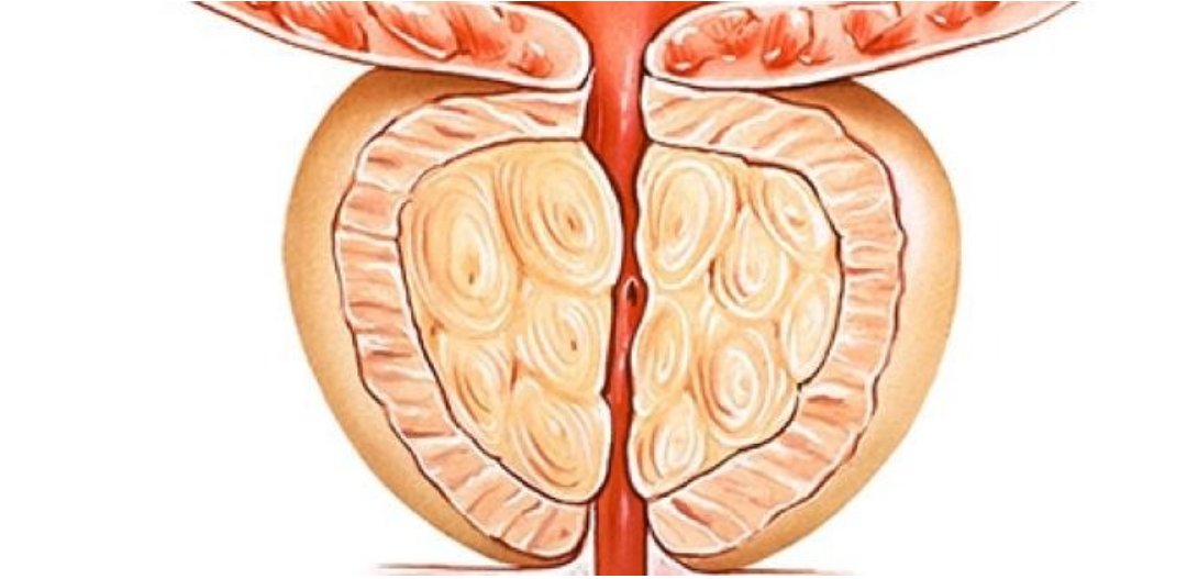 Prostatectomie radicale robot-assistée